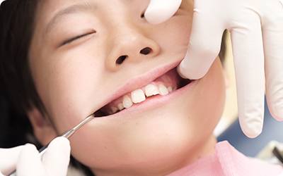 お子様の歯の歯並びの治療